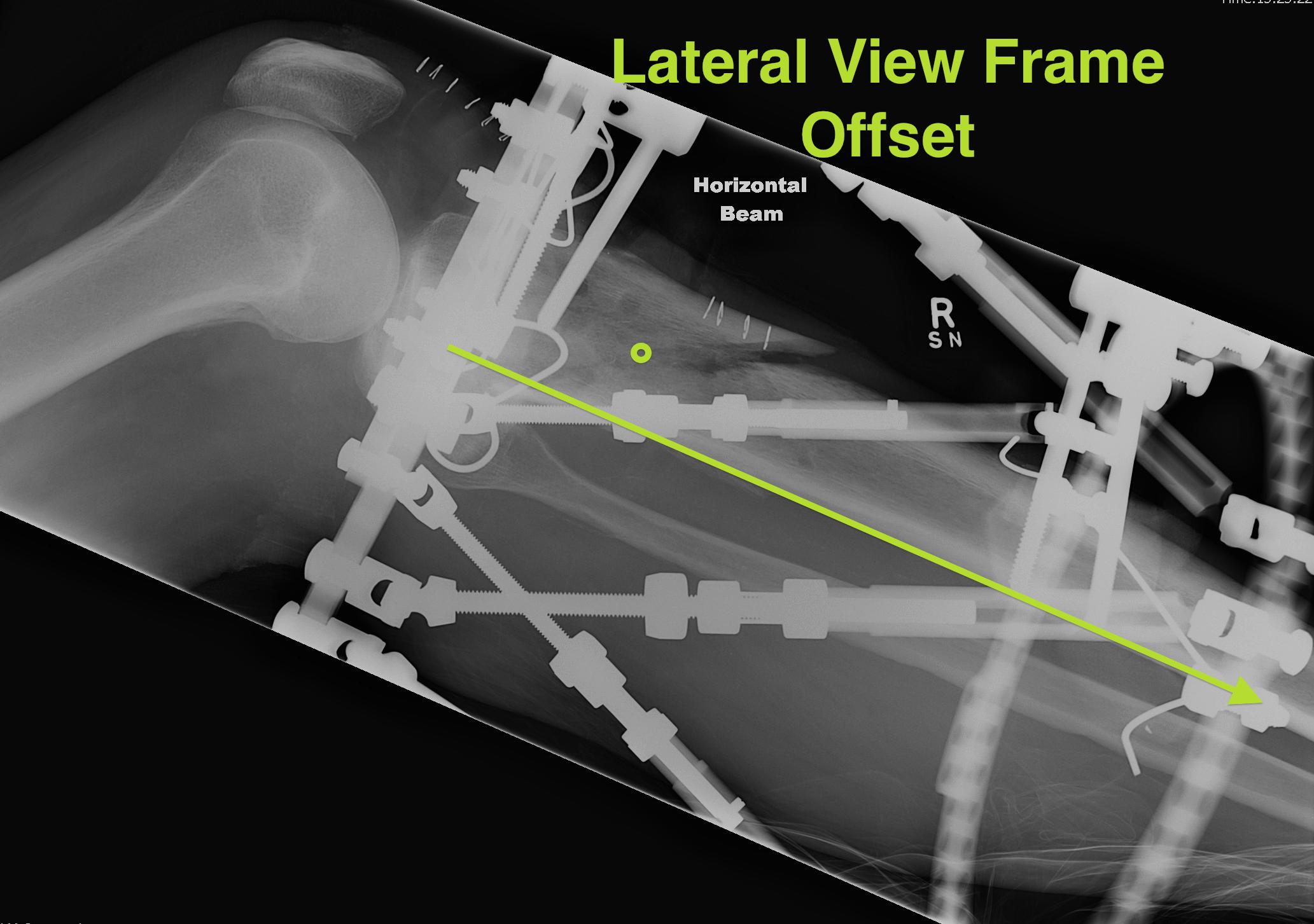 TSF Lateral View Frame Offset